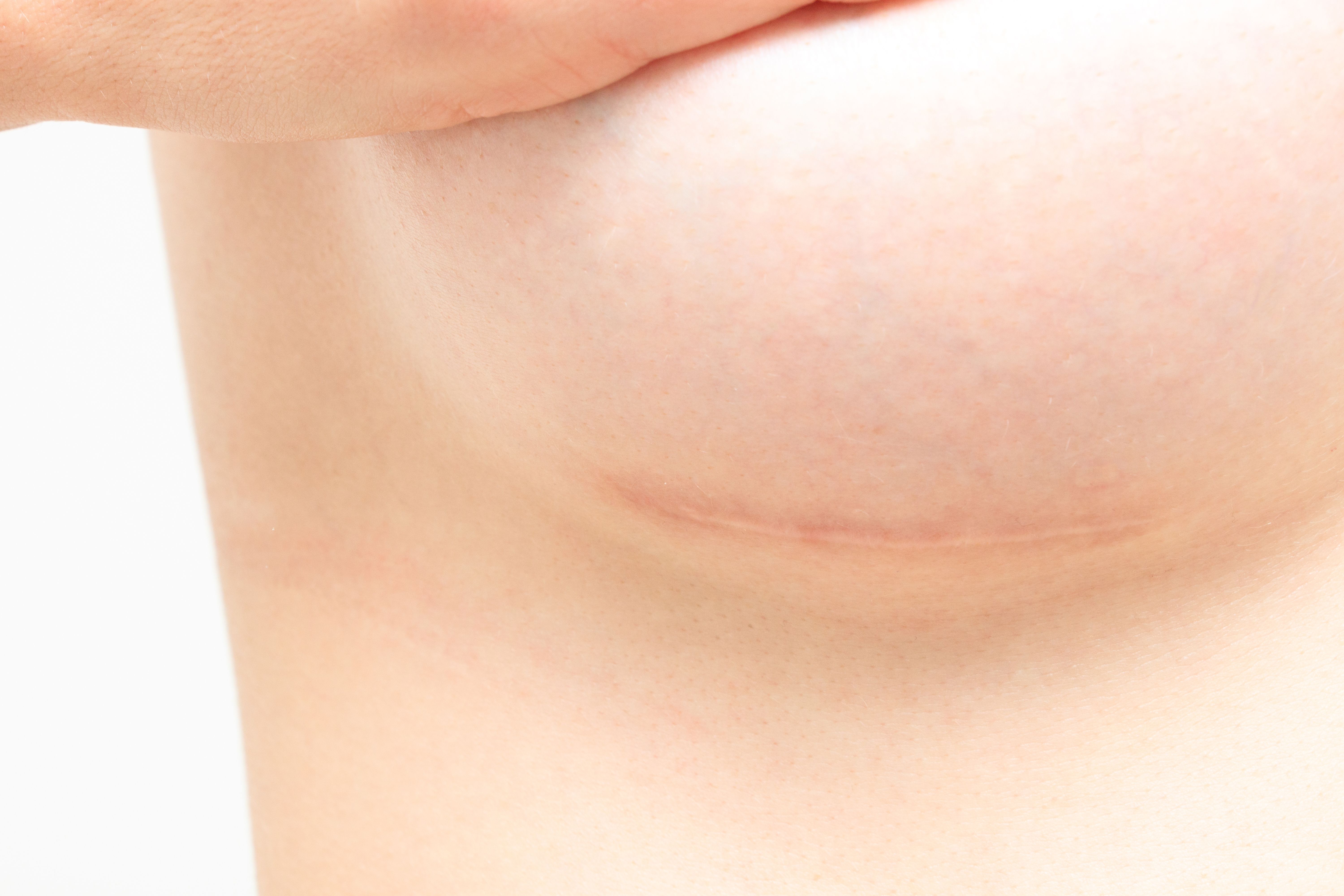 breast-augmentation-breast-implats-revision-surgery-reviews-best-surgeon.jpg